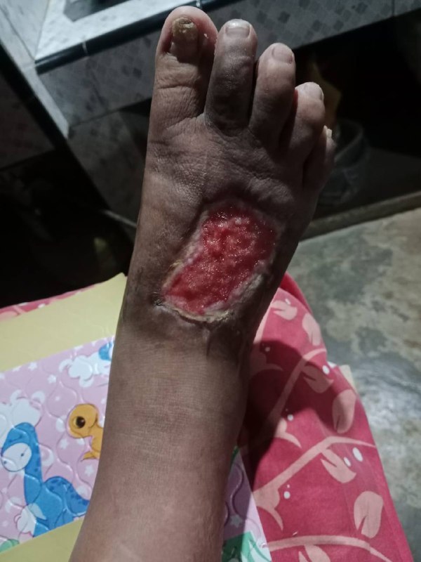 Bukti testimoni luka diabetes sembuh